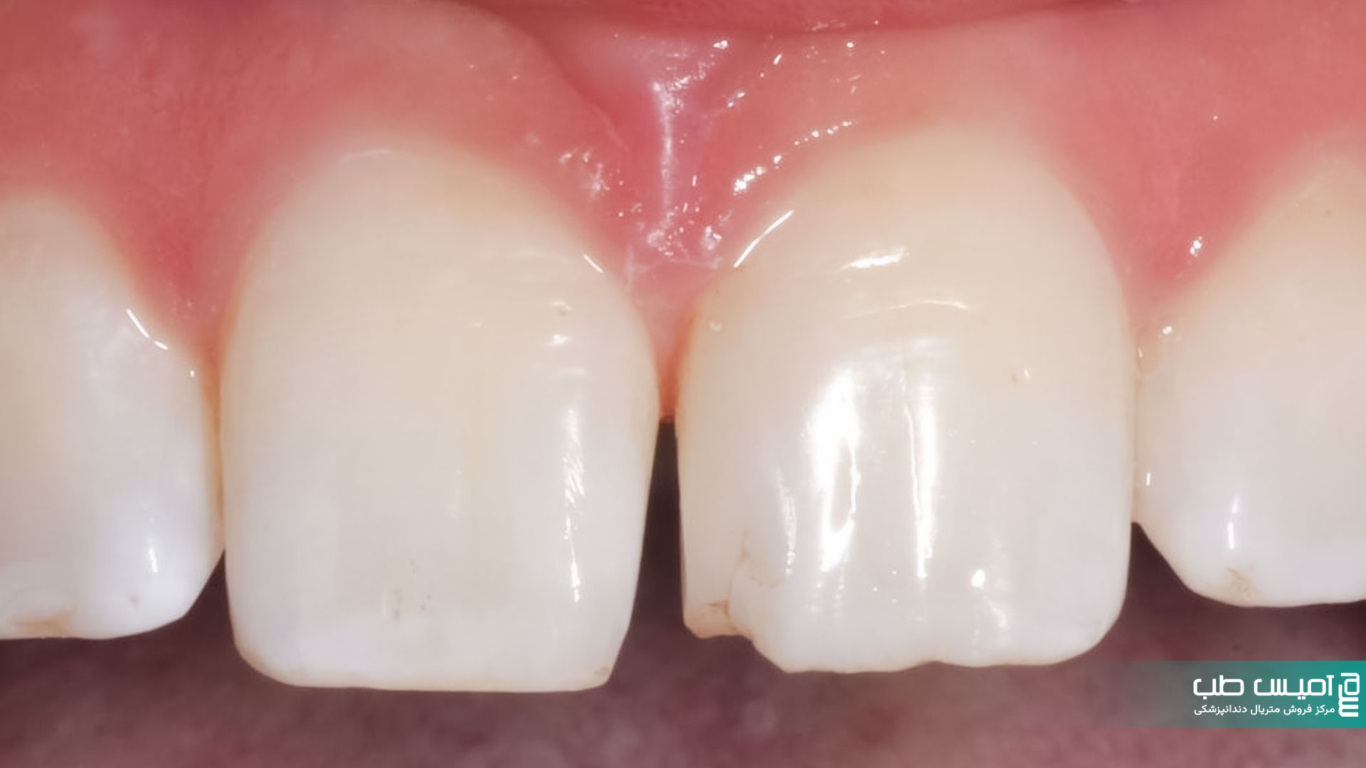 لب پر شدن کامپوزیت دندان تعمیر شکستکی کامپوزیت دندان ونیر دندان