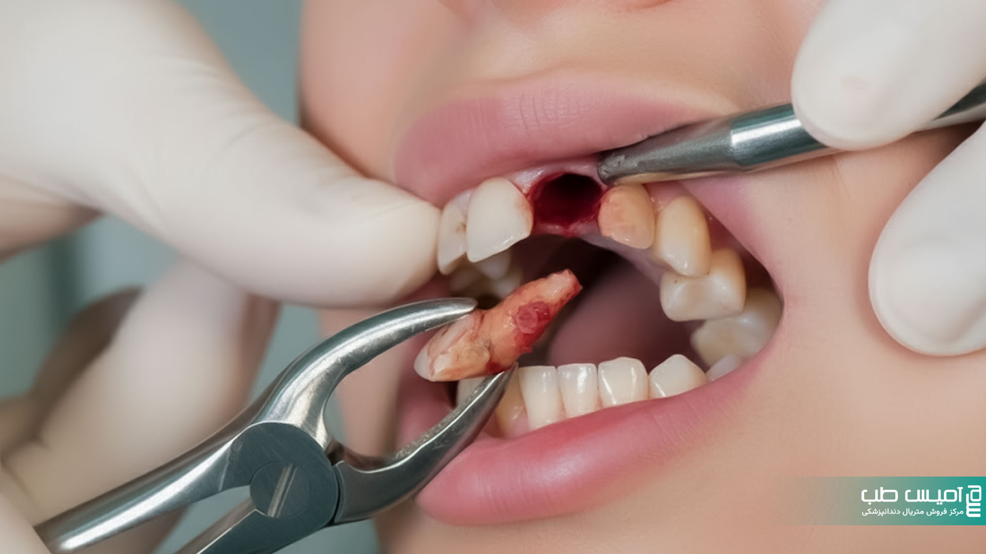 مکیدن دندان بعد از کشیدن؛ چرا ممنوع است و چه عوارضی دارد؟